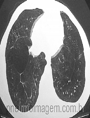 REVIS�O SOBRE DEFICI�NCIA DE ALFA-1 ANTITRIPSINA